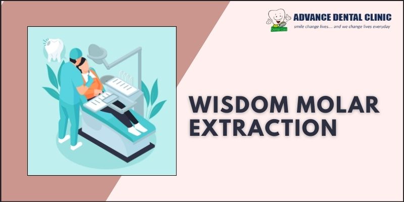 Wisdom Molar Extraction In Gtb Nagar | Advancedentalclinic